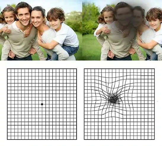 age-related-macular-degeneration